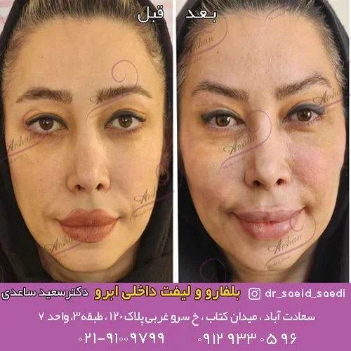 آیا عمل بلفاروپلاستی چشم عوارض دارد؟