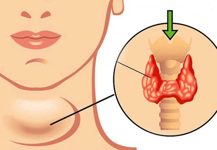 رژیم غذایی کم کاری تیروئید و غذاهای ممنوعه