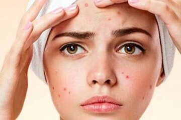 پنج ماده ای که به مبارزه با آکنه کمک می کند